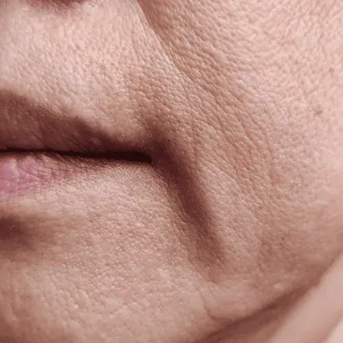 Skin Laxity & Sagging