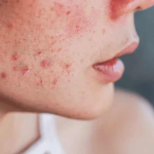 Hyperpigmentation & Sun Damage