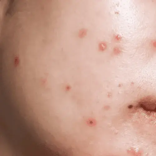 Scarring & Uneven Texture